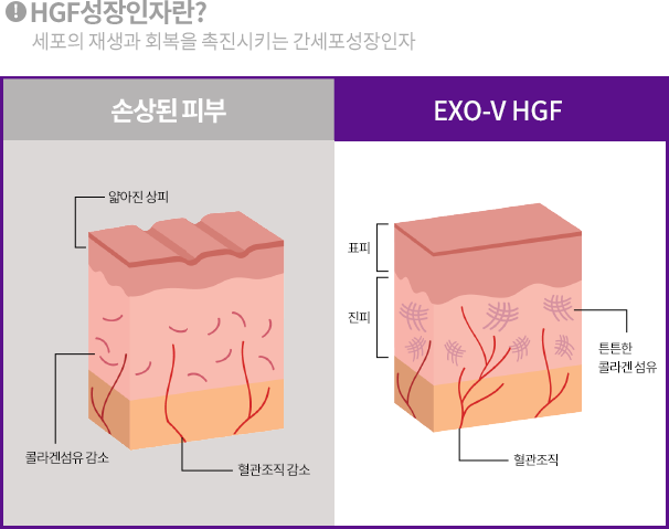EXO-V HGF